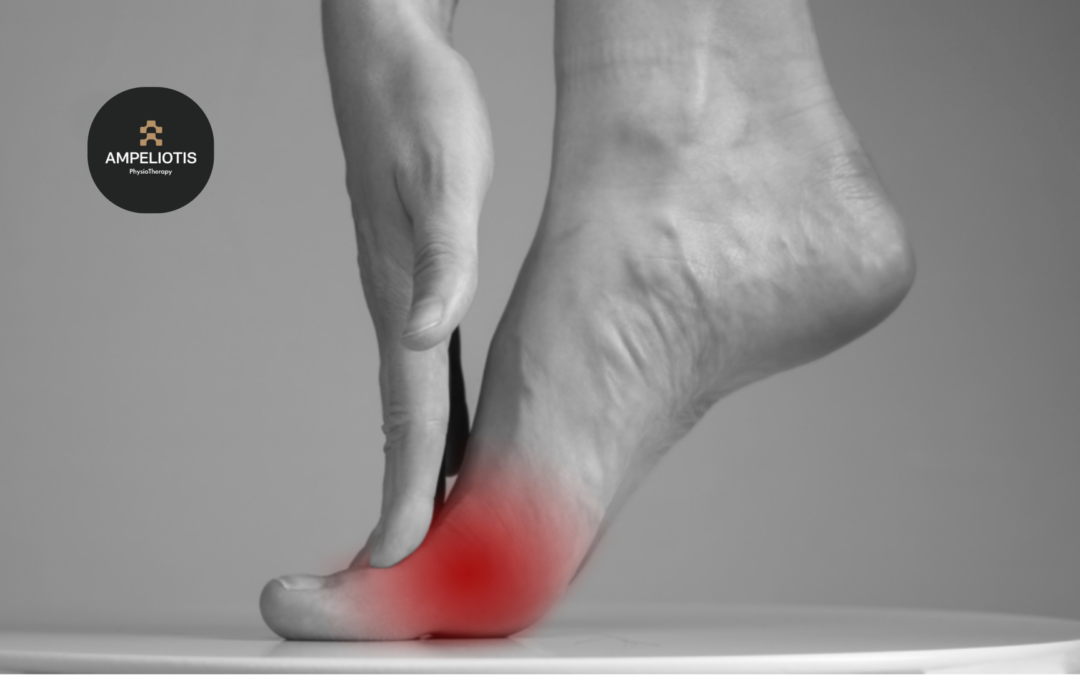 Φυσικοθεραπεία και Νεύρωμα Μόρτον (Morton neuroma)